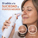 REMOVEDOR DE ESPINILLAS Y PUNTOS NEGROS